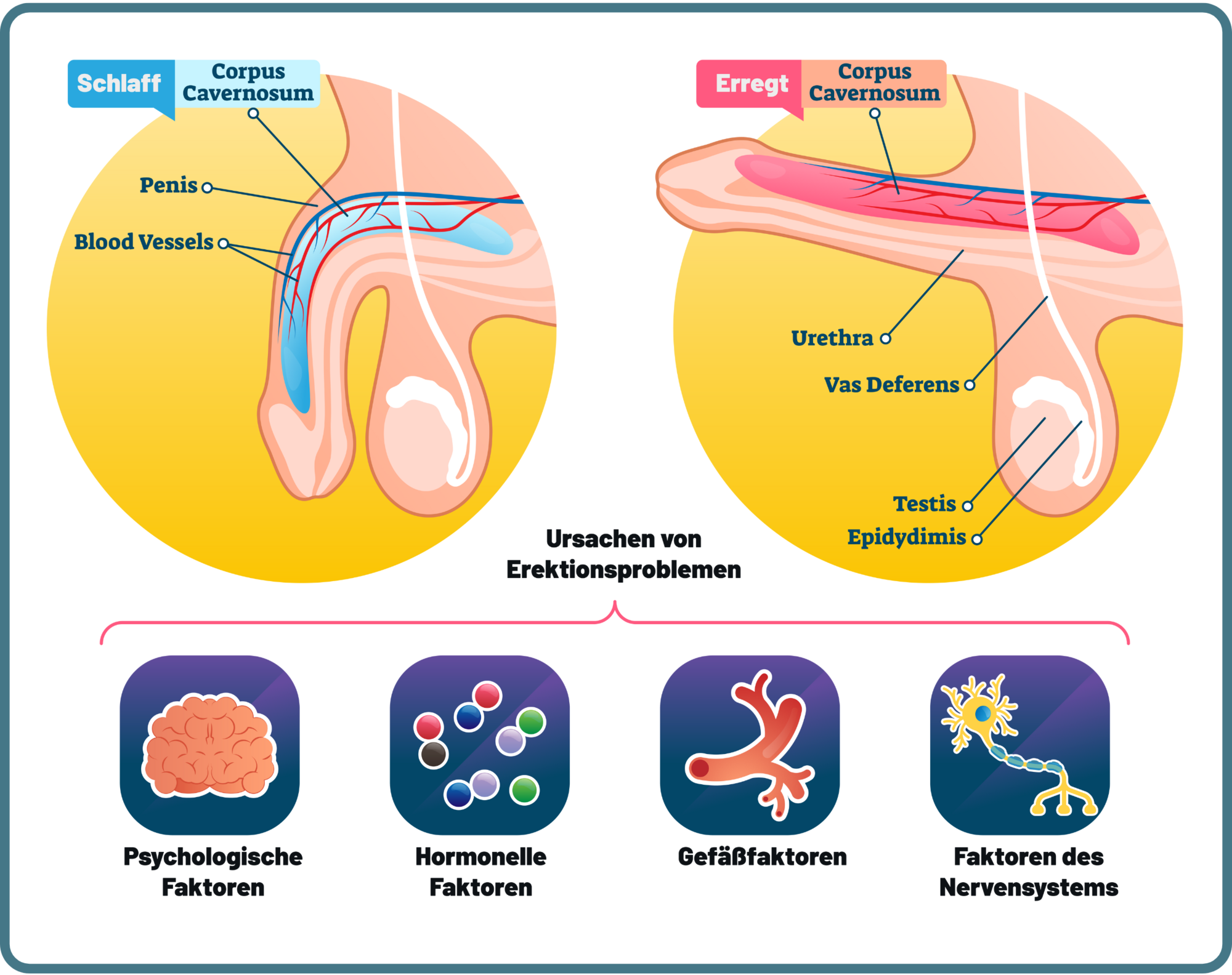 Ursachen von Erektionsproblemen